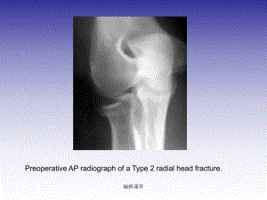 桡骨小头骨折切开内固定课件.ppt