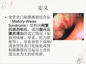 食管贲门粘膜撕裂综合征课件.pptx