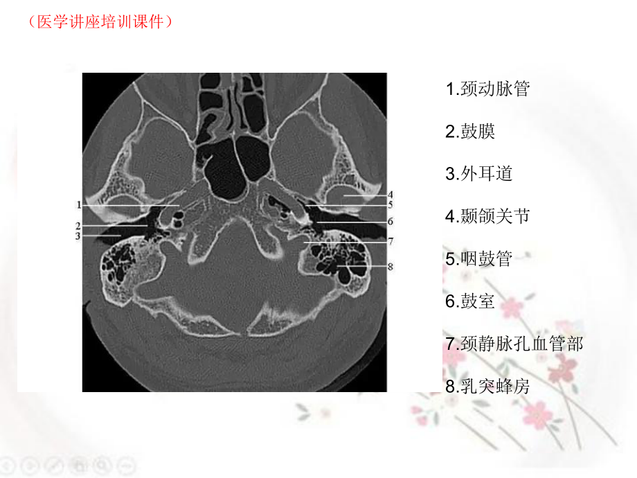 颞骨正常CT解剖(医学讲座培训课件).ppt_第3页