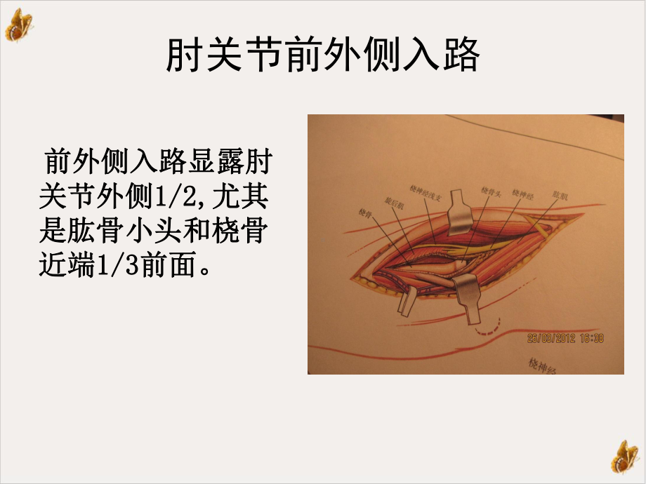 桡骨头及桡骨近端的手术入路与解剖课件.ppt_第3页