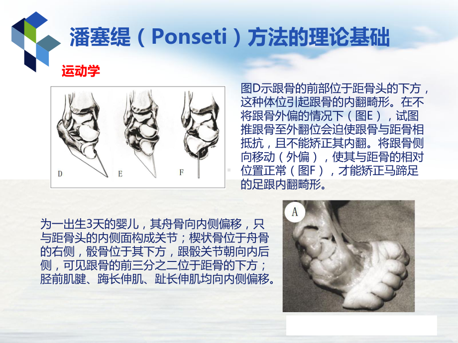 马蹄内翻足潘塞缇治疗法讲课课件.pptx_第3页