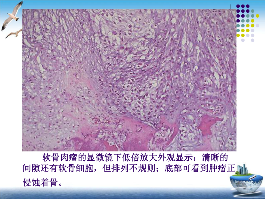 软骨肉瘤的病理及影像学表现课件.pptx_第1页