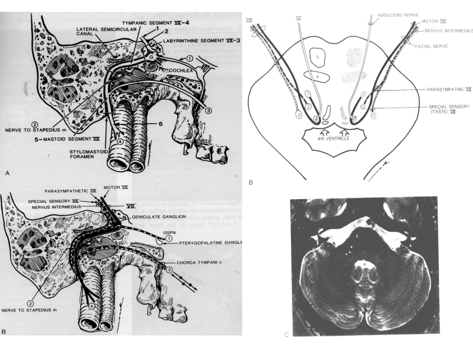 面神经的影像学诊断ppt课件.ppt_第3页