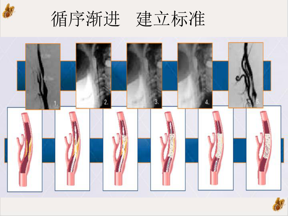 颈动脉支架手术步课件.pptx_第1页