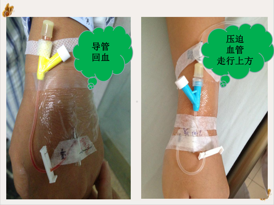 静脉留置针临床操作规范培训课程课件.ppt_第2页