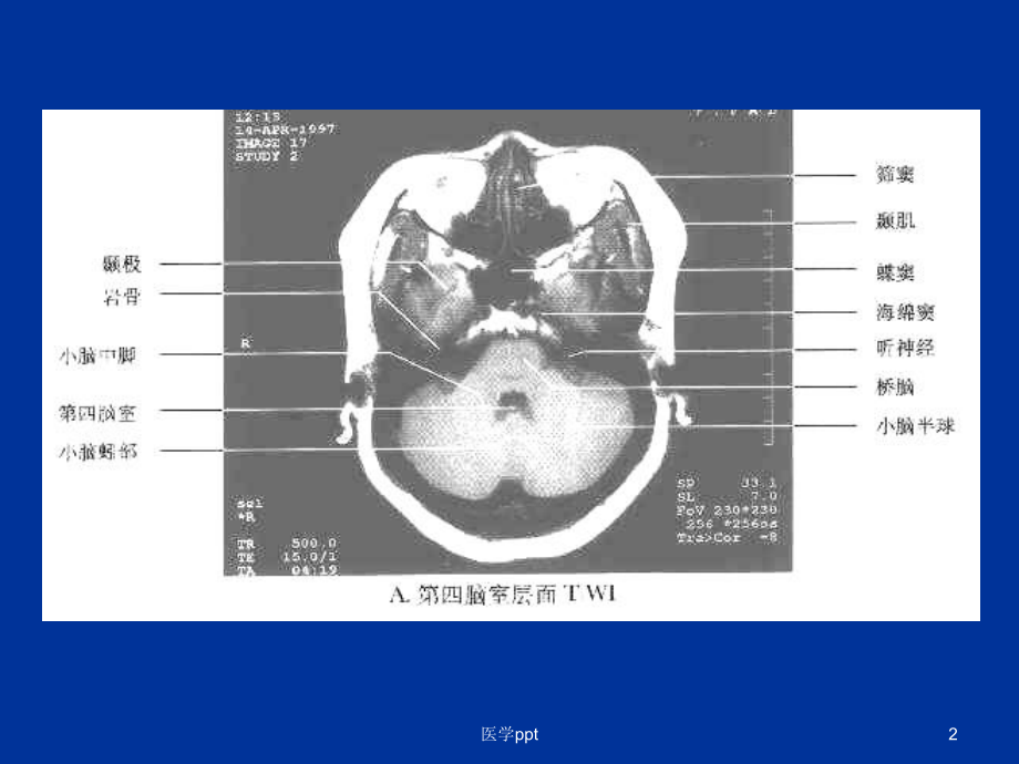 枢神经系统常见肿瘤的mri诊断课件.ppt_第2页