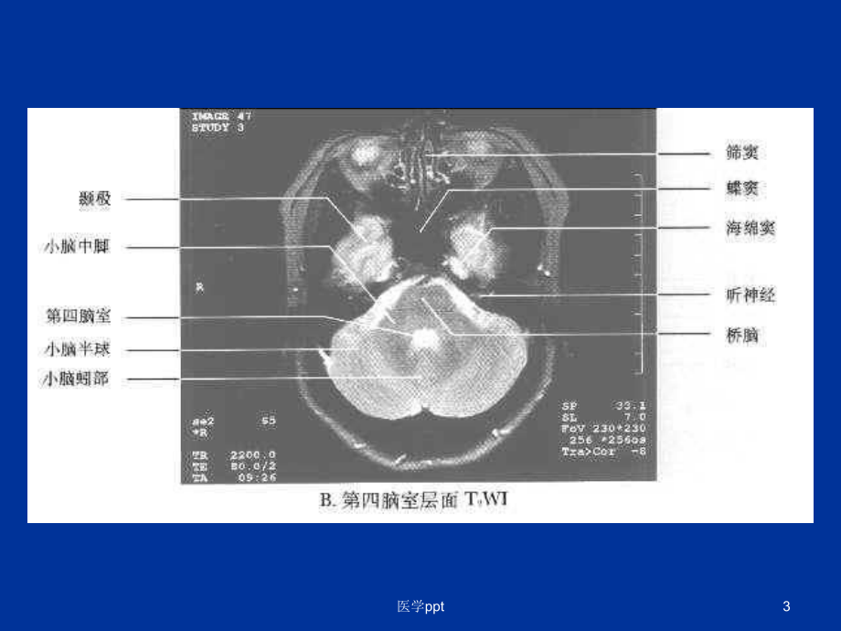 枢神经系统常见肿瘤的mri诊断课件.ppt_第3页