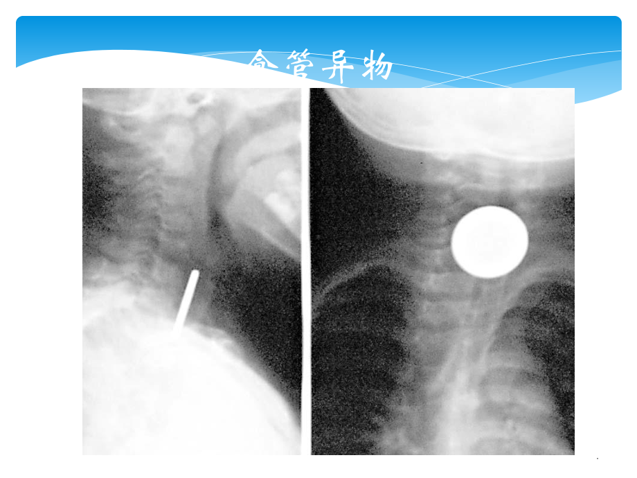 食管与胃疾病课件.ppt_第3页