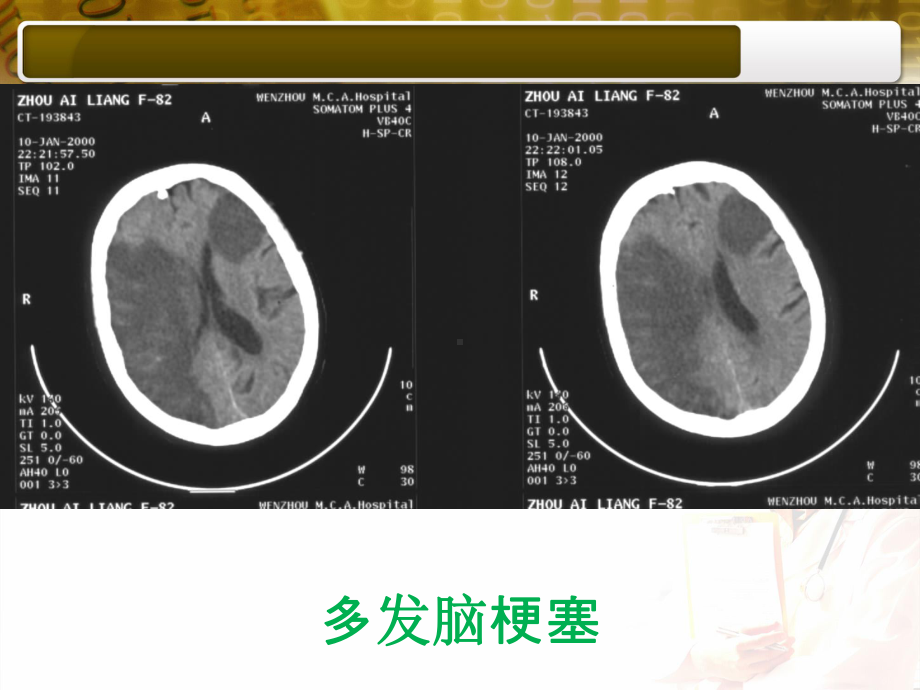 部分常见疾病CT影像课件.ppt_第2页