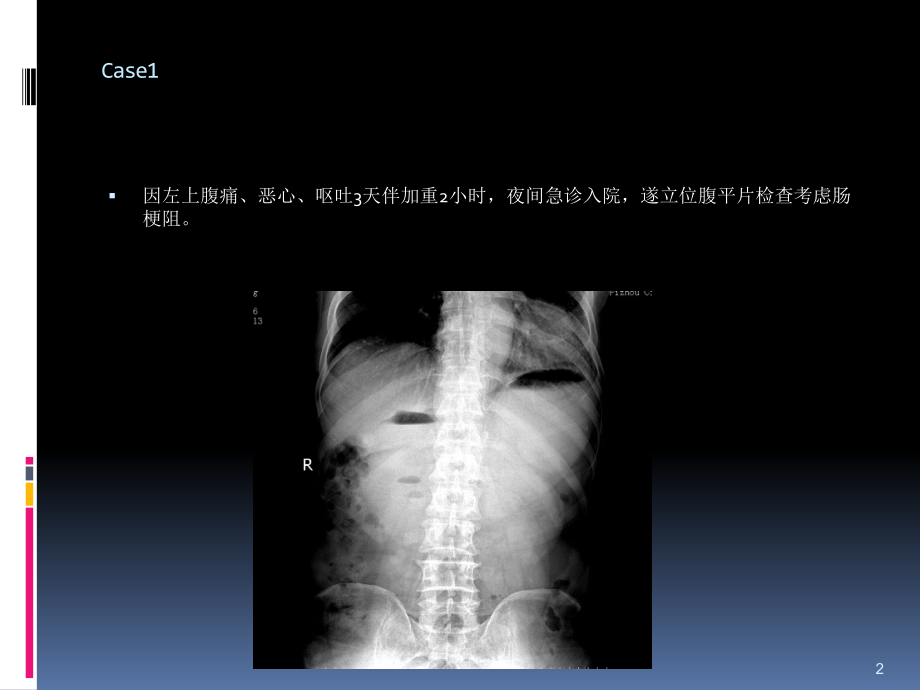 阑尾炎肠梗阻读片课件.ppt_第2页