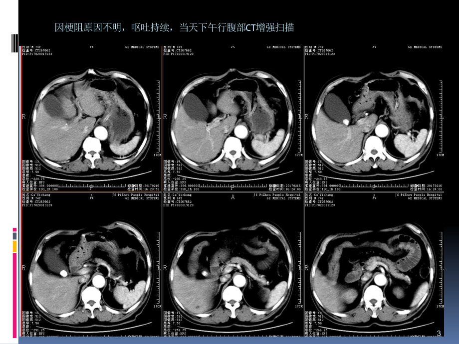 阑尾炎肠梗阻读片课件.ppt_第3页