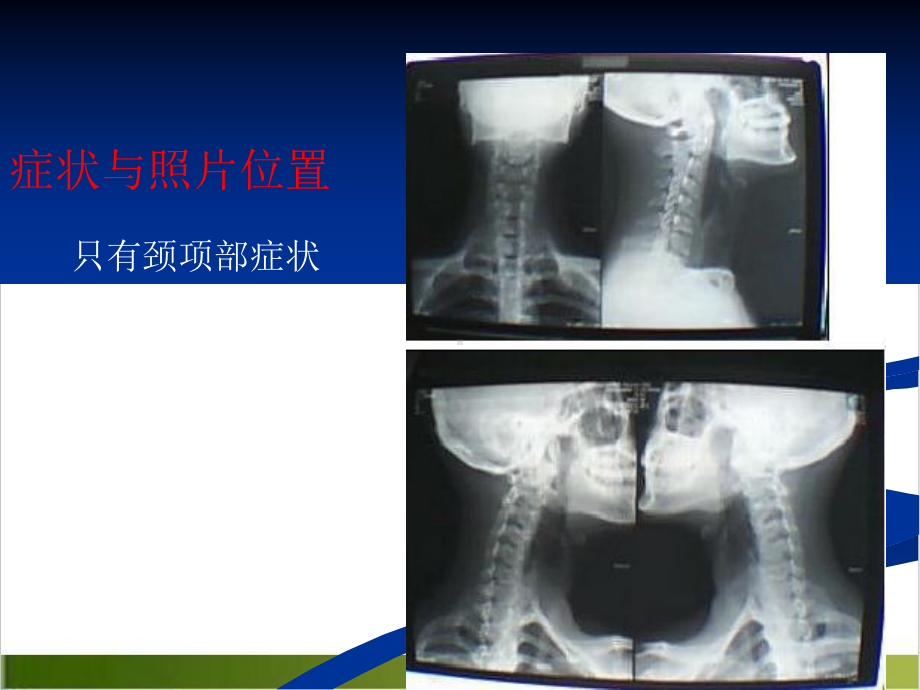 颈椎X光片阅读课件.pptx_第2页