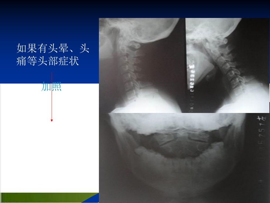 颈椎X光片阅读课件.pptx_第3页