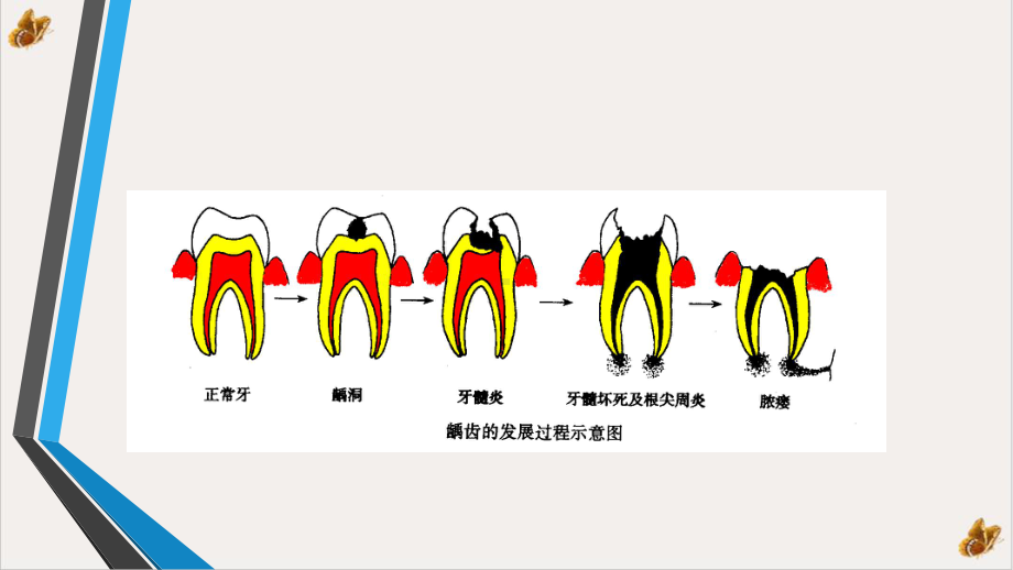 龋齿的治疗培训课件.pptx_第3页