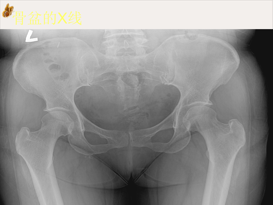 骨盆与髋臼骨折课件.pptx_第3页