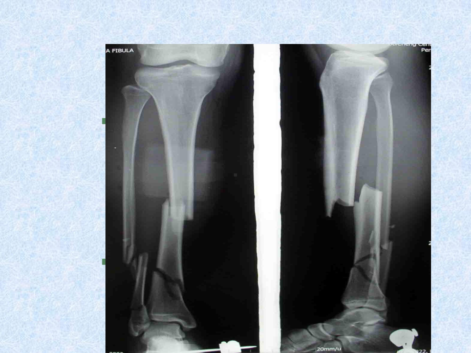 骨科教学护理查房—胫腓骨骨折课件.ppt_第3页