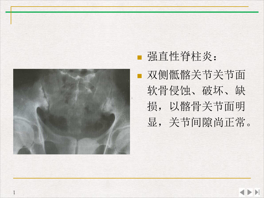 骨关节痹症课件.pptx_第1页