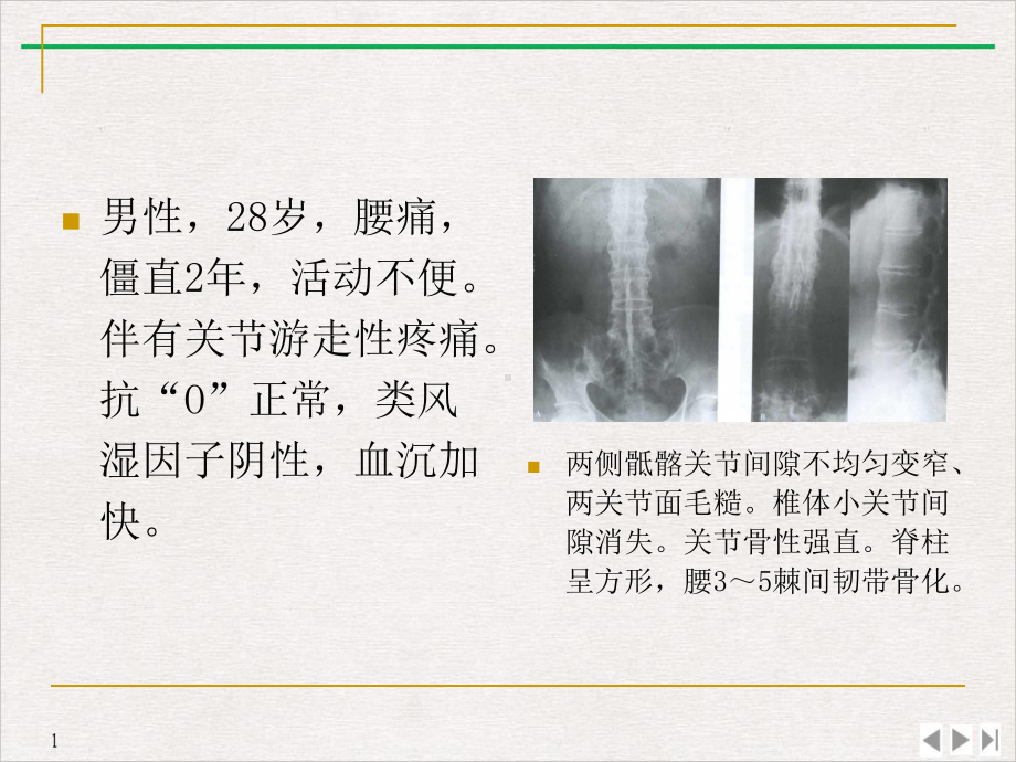 骨关节痹症课件.pptx_第2页