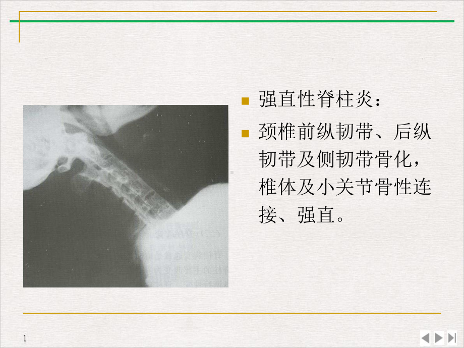 骨关节痹症课件.pptx_第3页