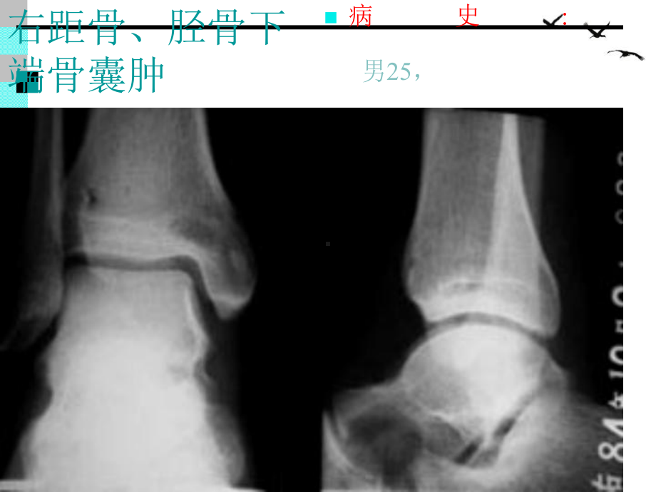 骨肿瘤X线病例图谱ONE课件整理.ppt_第2页