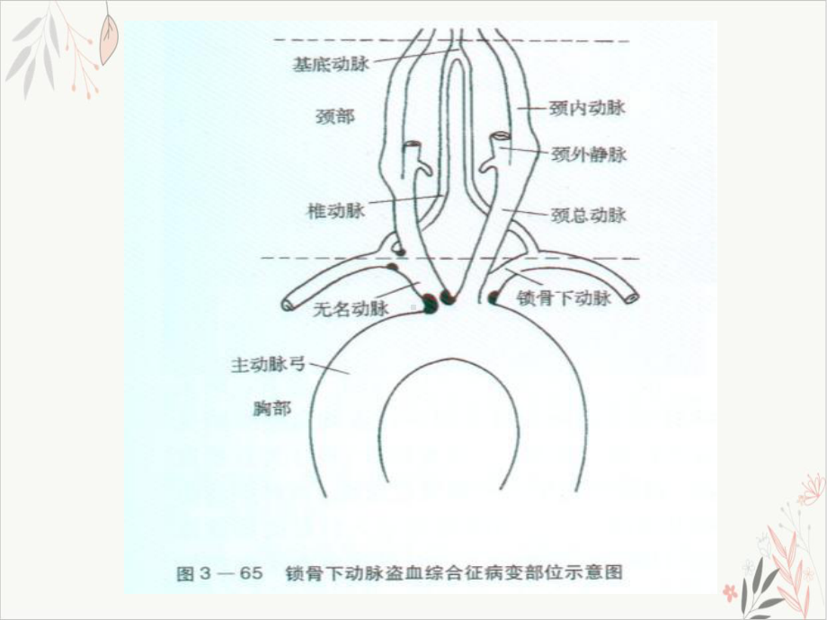 锁骨下动脉盗血综合征课件整理.ppt_第3页