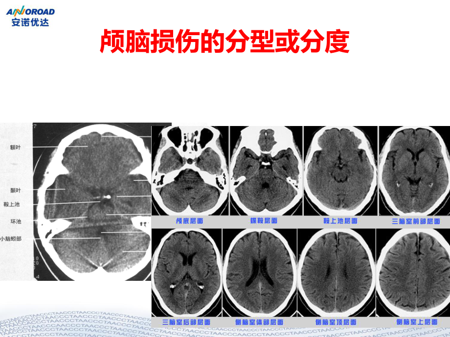 重度颅脑损伤监护与治疗课件.pptx_第2页