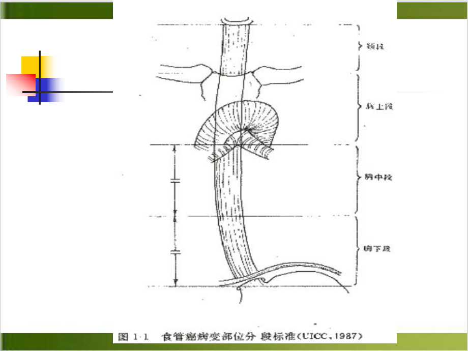 食管癌的治疗PPT课件.pptx_第3页