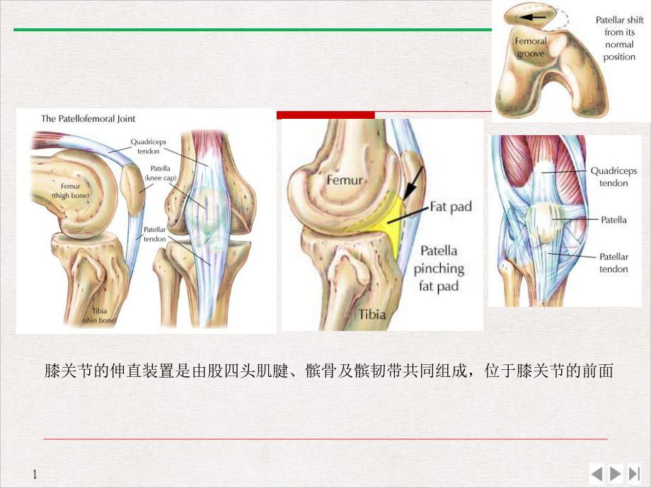 髌骨骨折康复完美课课件.pptx_第1页