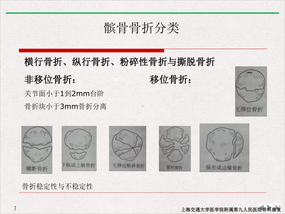 髌骨骨折康复完美课课件.pptx_第2页