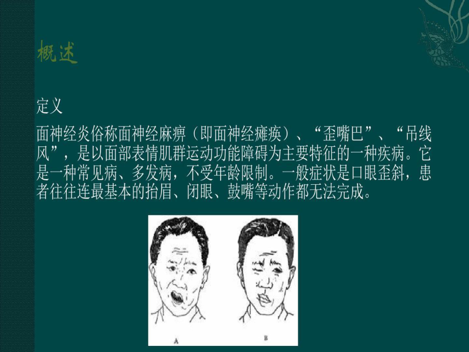 面瘫的护理查房课件整理.ppt_第3页