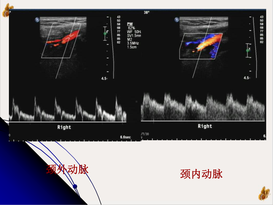 颈动脉椎动脉超声检查摘要课件.pptx_第3页