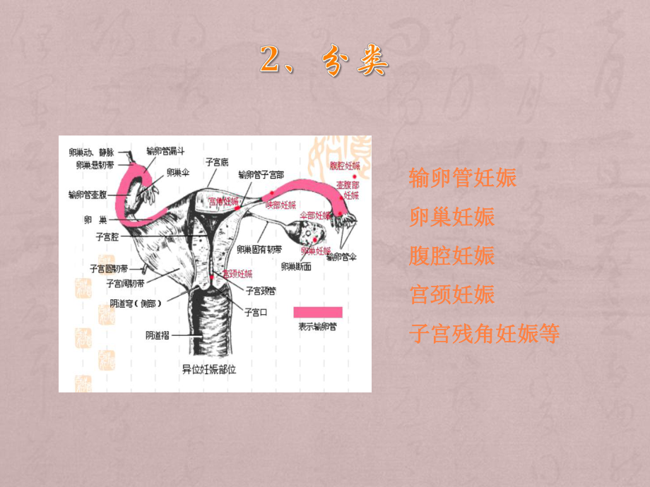 宫外孕的治疗与护课件.ppt_第3页