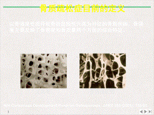 骨质疏松症内科讲课宁南(最新版)课件.pptx