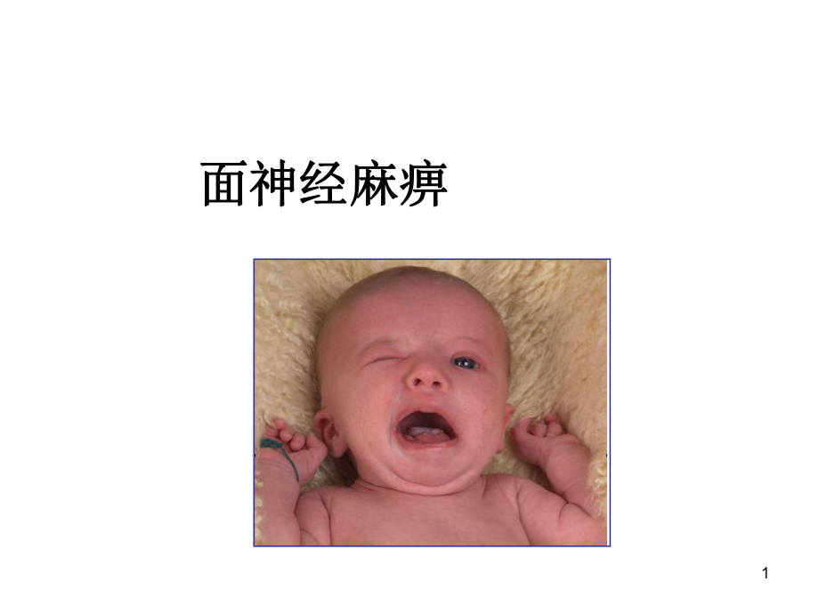 面神经麻痹课件整理.ppt_第1页