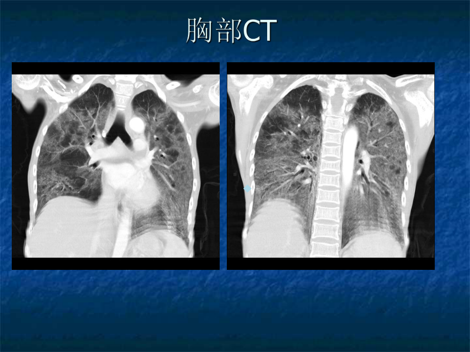 难治性肺炎课件.ppt_第3页