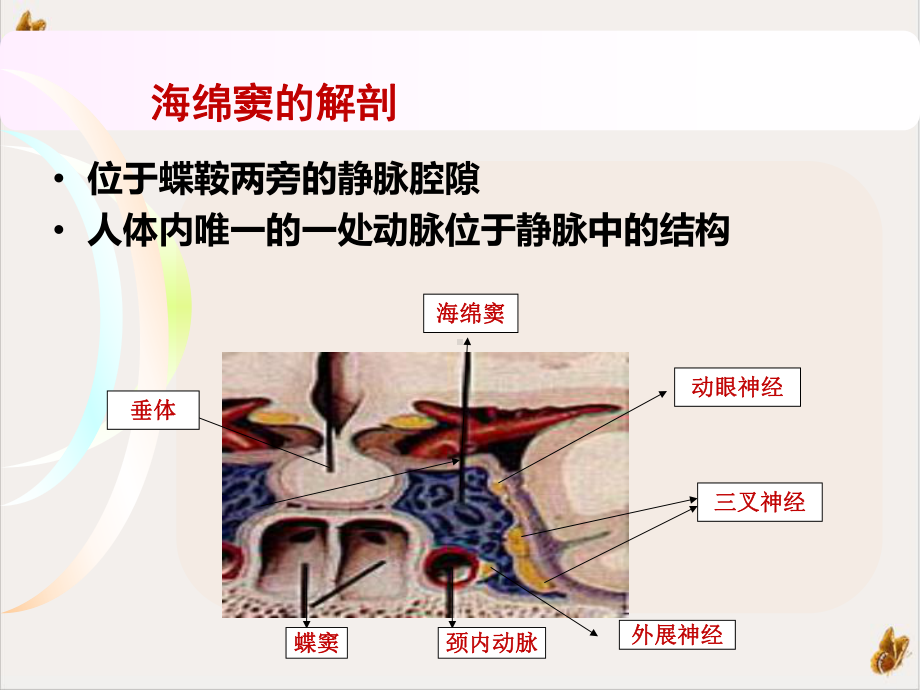 颈内动脉海绵窦瘘的诊治课件.pptx_第2页