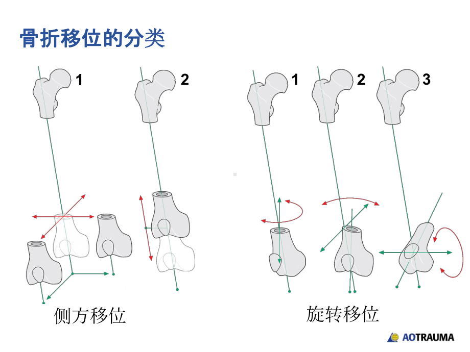 关节骨折复位课件.ppt_第3页