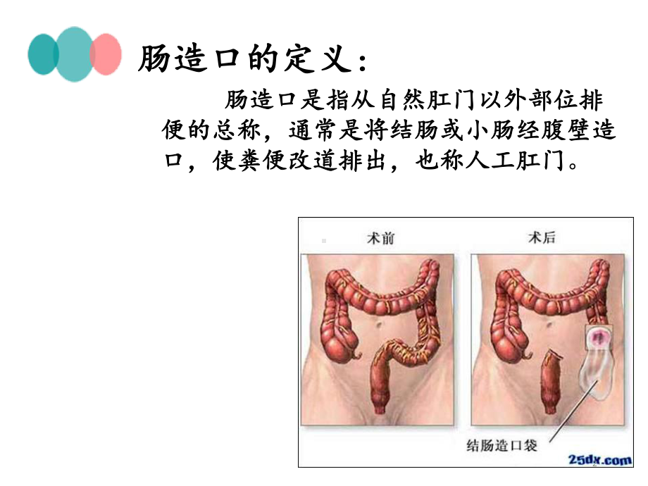 造口选择与护理课件.ppt_第2页