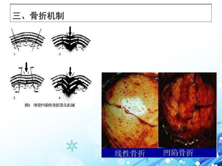 颅骨骨折护理查房演示教学课件课件.ppt_第3页