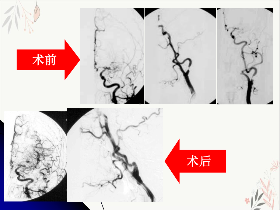 颈内动脉内膜剥脱术课件.pptx_第2页