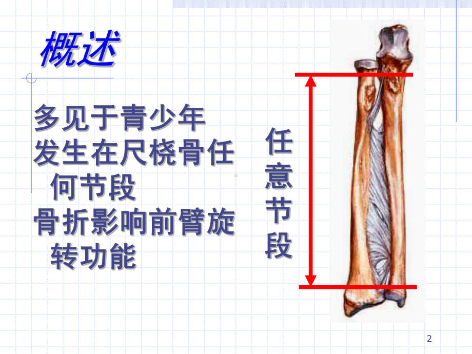 桡骨尺双骨折课件.ppt_第2页