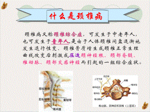 颈椎病术后的护理课件整理.pptx