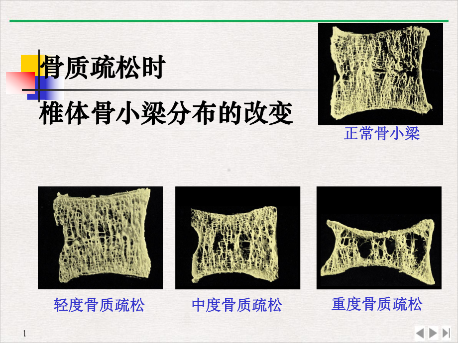 骨质疏松症的中西医结合治疗课件(同名1036).pptx_第2页