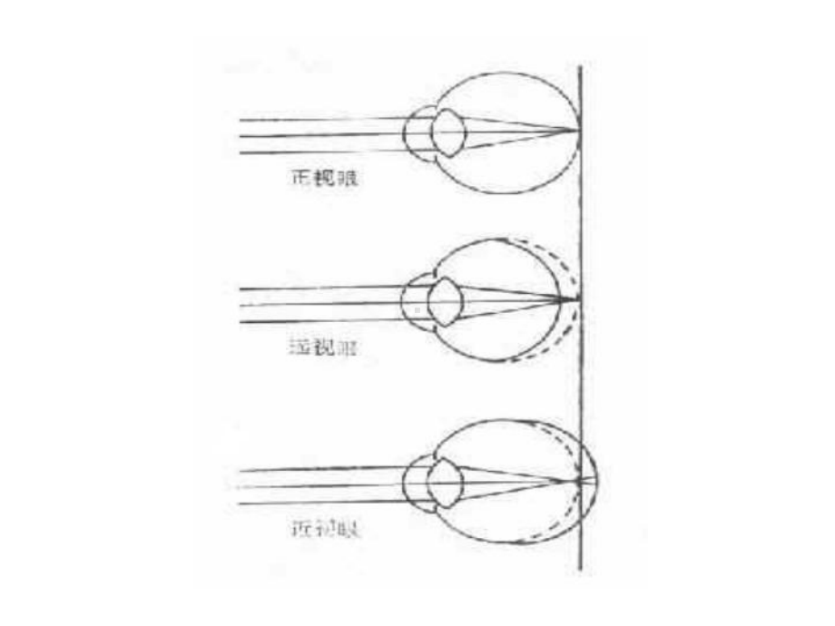 近视眼的临床防治新版课件.pptx_第3页