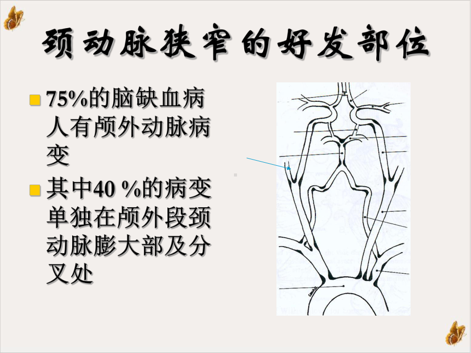 颈动脉狭窄的检测和诊断课件(同名209).ppt_第3页