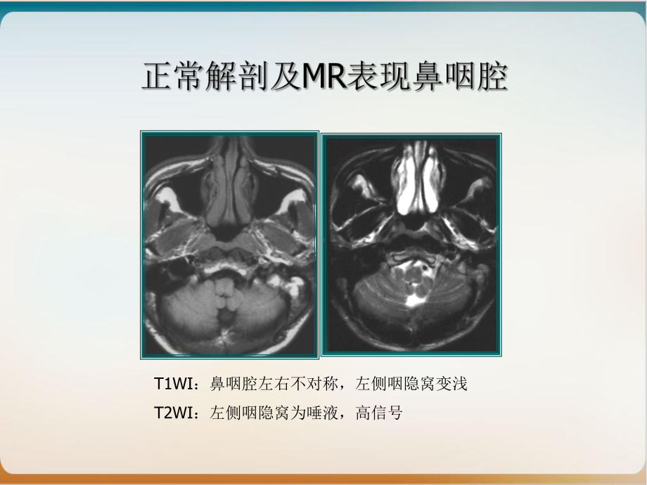 鼻咽癌MR诊断教学课件.ppt_第2页