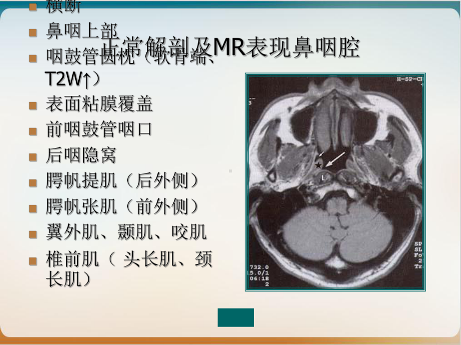 鼻咽癌MR诊断教学课件.ppt_第3页