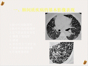 间质性肺疾病的CT诊断课件.pptx