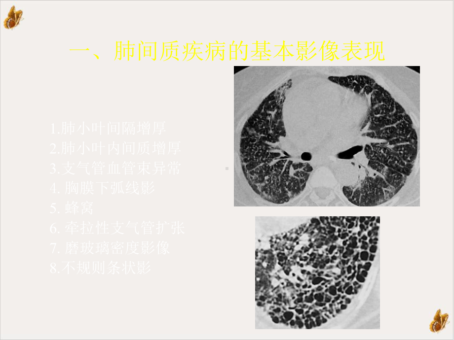 间质性肺疾病的CT诊断课件.pptx_第1页