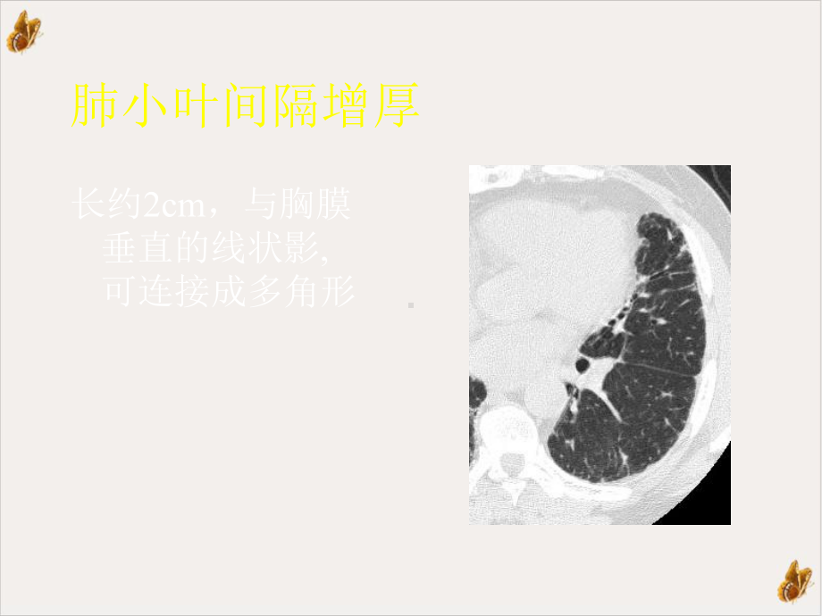 间质性肺疾病的CT诊断课件.pptx_第2页